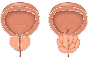 Prostate inflammation