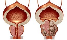 Healthy or unhealthy prostate