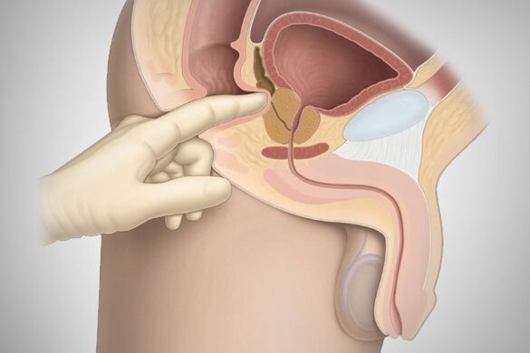 Prostate massage treats bacterial prostatitis