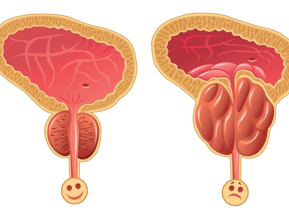 Healthy prostate and prostatic obstruction with congestive prostatitis