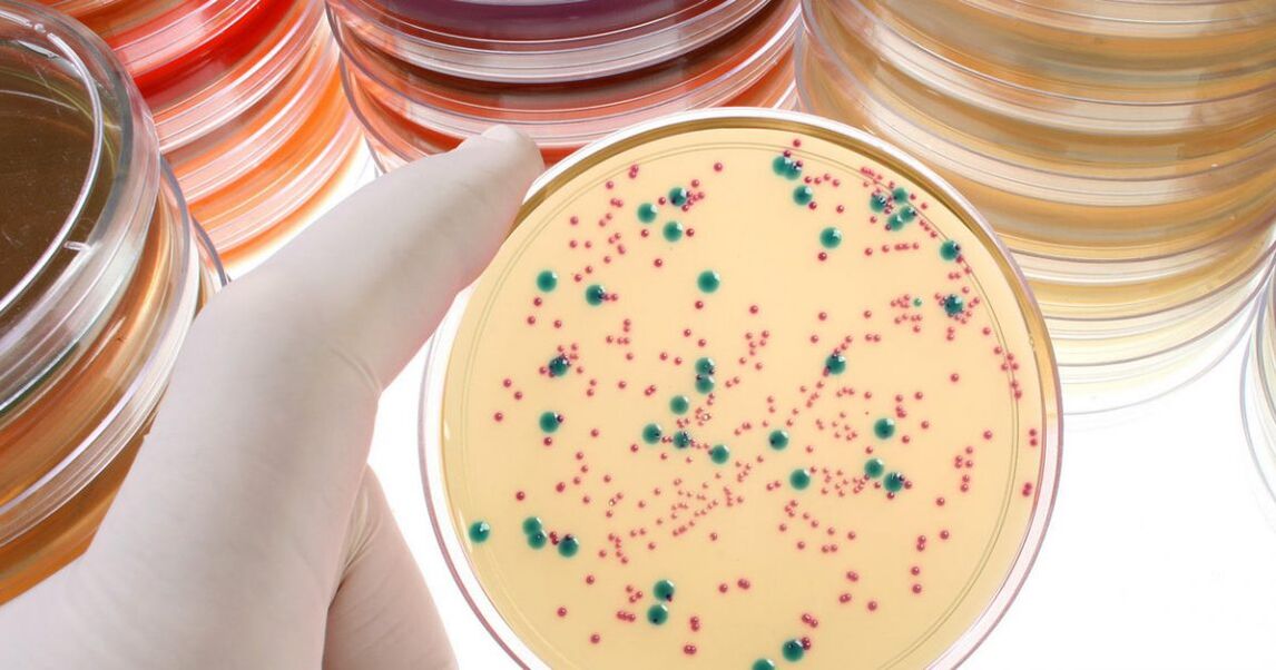 Chronic bacterial prostatitis is detected by analyzing urine and prostatic secretions