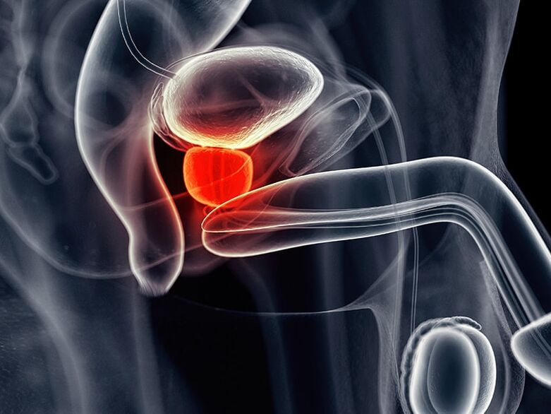 Prostatitis accompanied by chronic prostatitis