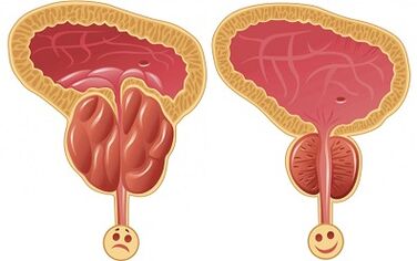 how Prostalix affects prostatitis before and after treatment
